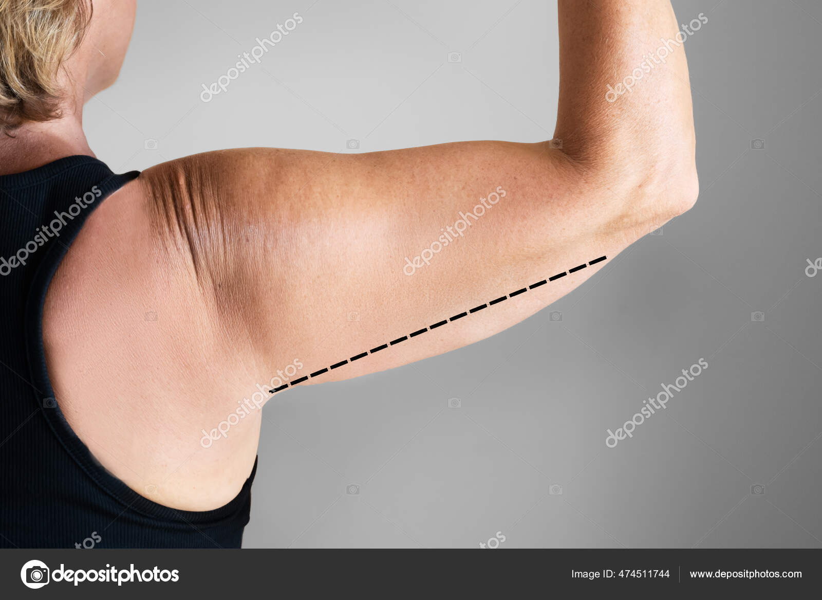 Excess Fat Under Biceps Overweight Lady Arm Excess Fat People