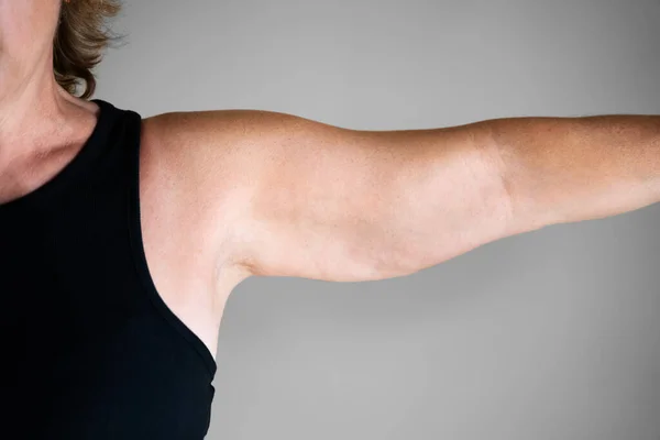 Υπερβολικό Βάρος Γυναικείο Χέρι Περίσσεια Λίπους Παχυσαρκία — Φωτογραφία Αρχείου