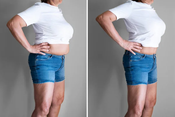 Voor Gewichtsverlies Liposuctie Chirurgie — Stockfoto