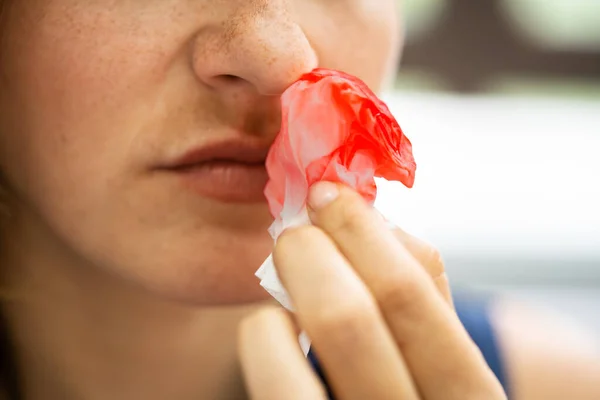 Mulher Tentando Parar Sangramento Sangue Nariz — Fotografia de Stock