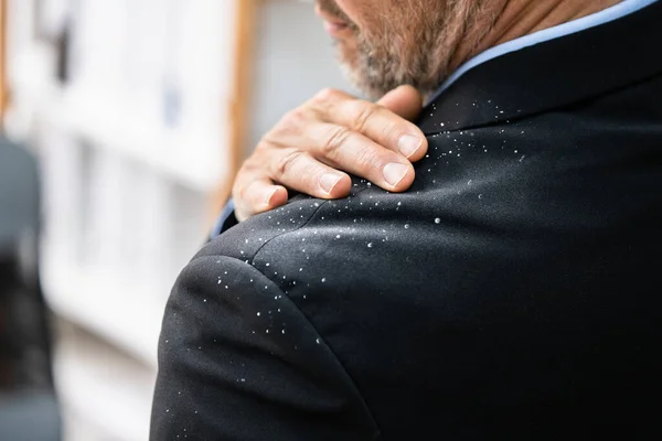 Man Dandruff Suit Shoulder Dirty Clothes — Stok fotoğraf