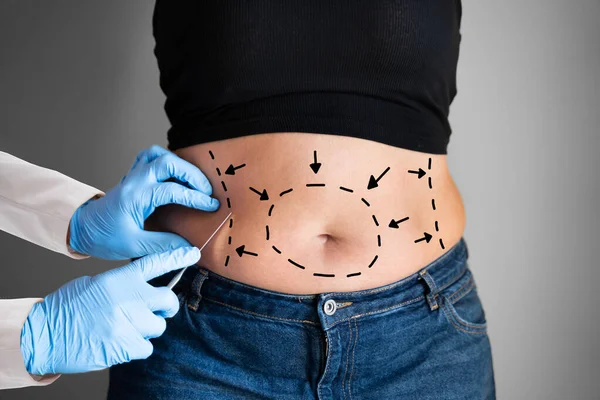 腹部形成性肥満の手術 審美的な腹部脂肪脂肪吸引 — ストック写真