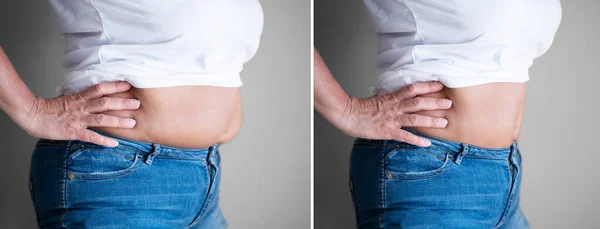 Vor Und Nach Der Gewichtsabnahme Fettabsaugung — Stockfoto