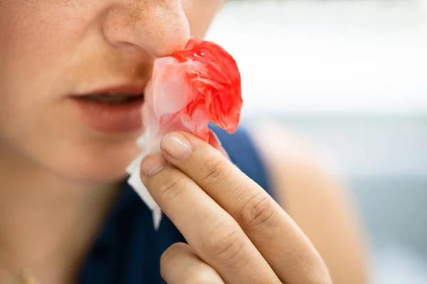 Wanita Yang Mencoba Menghentikan Pendarahan Darah Dari Hidung — Stok Foto