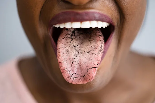 Kvinna Tungan Med Dåliga Bakterier Candidiasis Och Smärta — Stockfoto