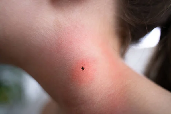 Enzephalitis Milbenkäfer Oder Arachnid Parasit Unter Der Kinderhaut — Stockfoto