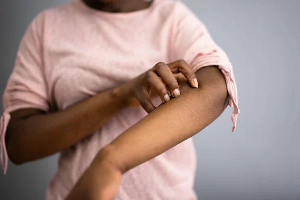 Afrikansk Amerikansk Kvinna Med Kliande Hud Allergi Eller Psoriasis — Stockfoto