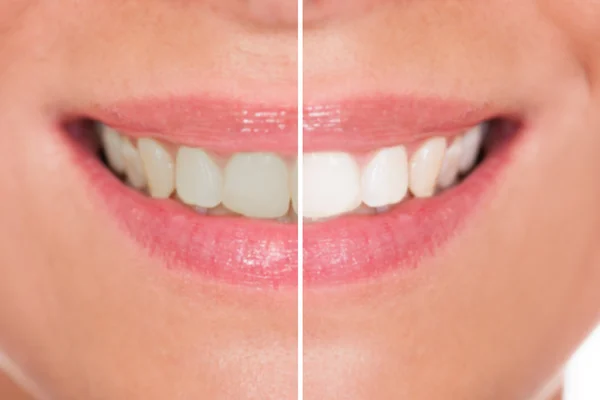 Dientes antes y después del blanqueamiento — Foto de Stock