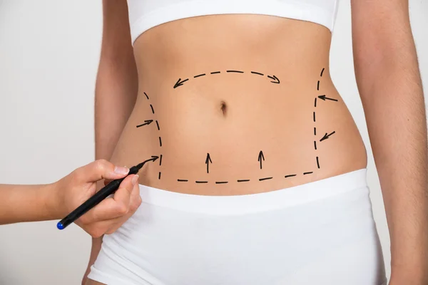 How To Prepare For Liposuction Surgery? Dos and Don'ts | Stock Photo
