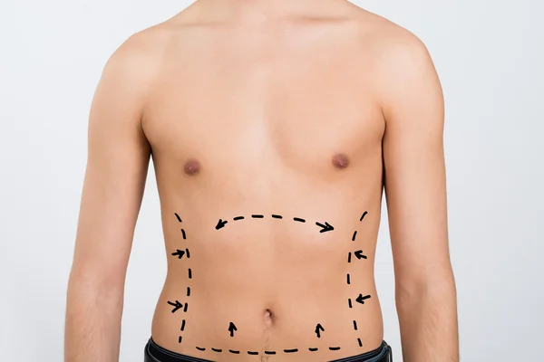 Abdomen del hombre con líneas de corrección — Foto de Stock