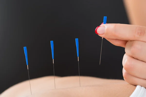 Terapeuta wprowadzenie igły akupunktury na kobiety z powrotem — Zdjęcie stockowe