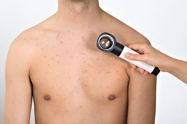 Examinando a pele da acne do homem — Fotografia de Stock
