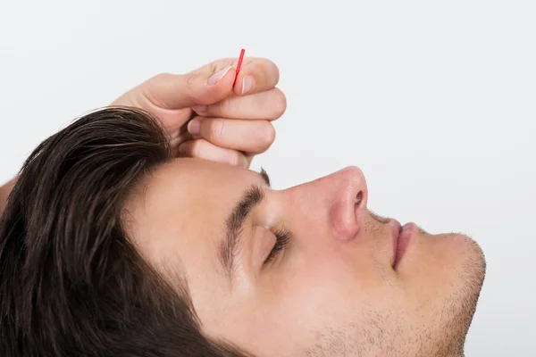 Muž akupunkturní léčby — Stock fotografie
