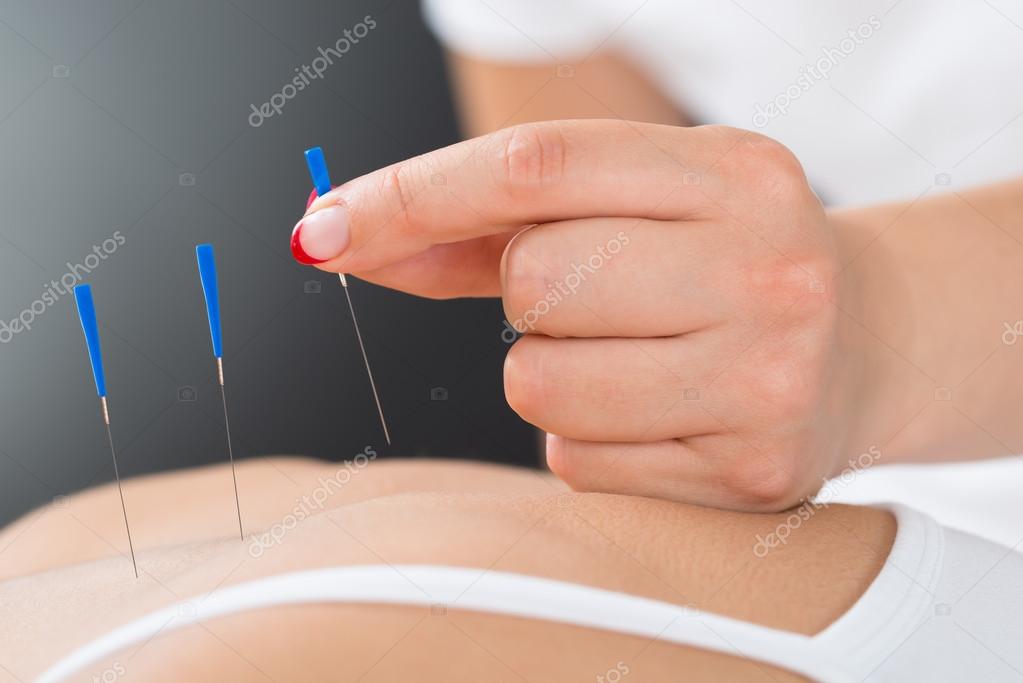 Therapist Putting Acupuncture Needle