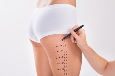 Kadın Liposuction cerrahi uylukta hazırlama