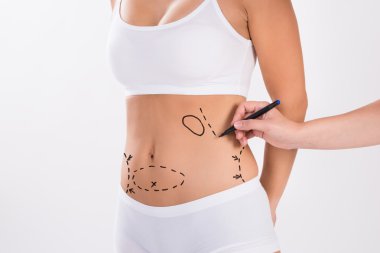 Cerrah kadın Liposuction cerrahi için hazırlanıyor