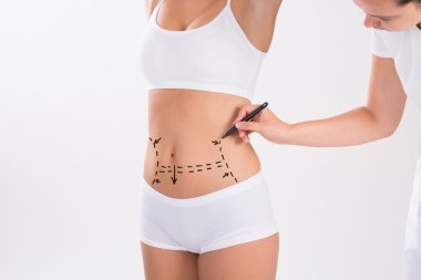 Surgeon Preparing Woman For Liposuction Surgery clipart