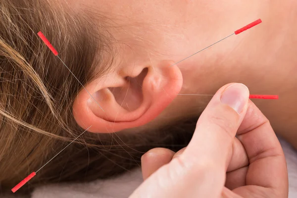 耳介に鍼治療を行う手 — ストック写真