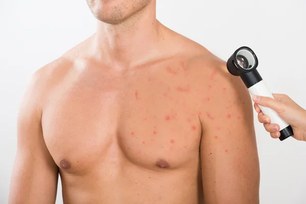 Médico que verifica a pele da acne do homem — Fotografia de Stock