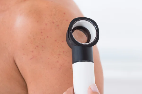 Doctor Checking Acne Skin Of A Man — Stock Photo, Image