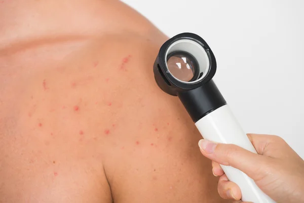 Acne esaminante della mano della persona — Foto Stock