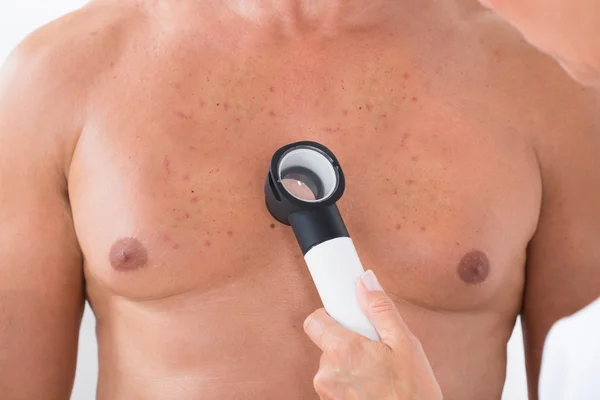 Undersöka akne hud med Dermatoscope — Stockfoto