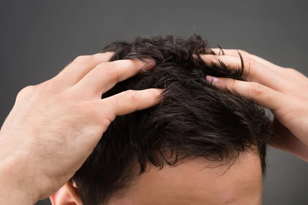 Man Suffering From Dandruff — Stock Photo, Image