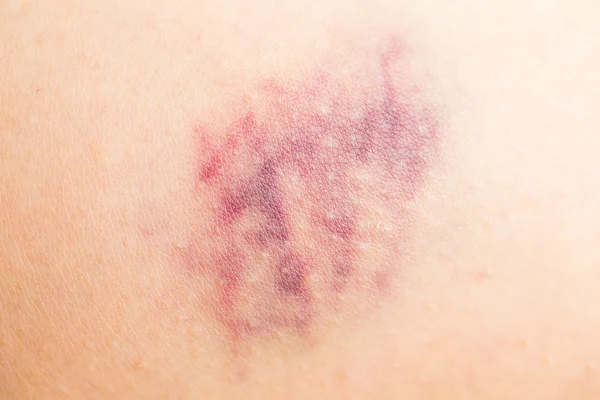 Bruise op gewonde huid — Stockfoto