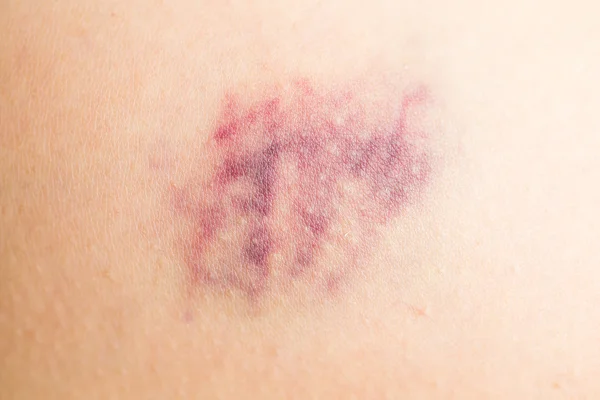 Bruise on wounded skin - Stock Image. 