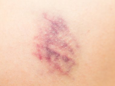 Bruise on wounded skin clipart