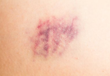 İnsan bacak çürük