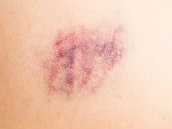 Bruise on wounded woman leg skin — Stock Photo, Image