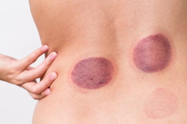 Vrouw met Cupping Therapie — Stockfoto