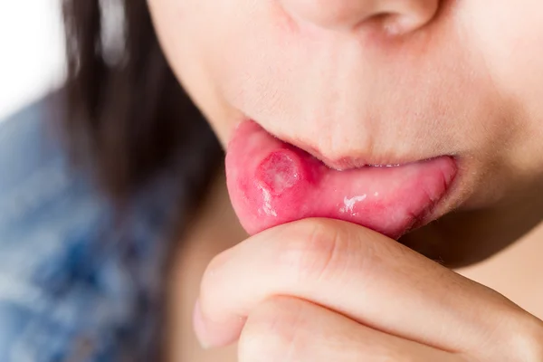 Mujer con estomatitis aftosa — Foto de Stock