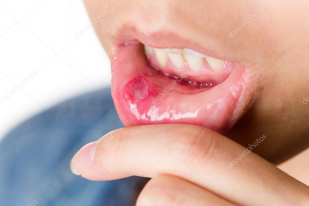 Woman suffer from mouth aphtha 