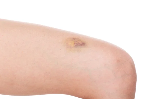 Woman leg with pain and a large bruise — Stock Photo, Image