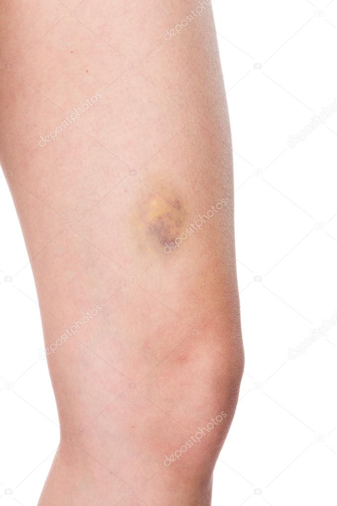 Bruise on woman leg