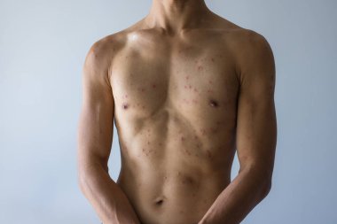 Alerji alerjisi olan erkek gövdesi.