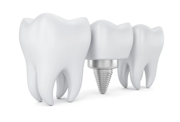 牙齿和牙科植入物 — 图库照片