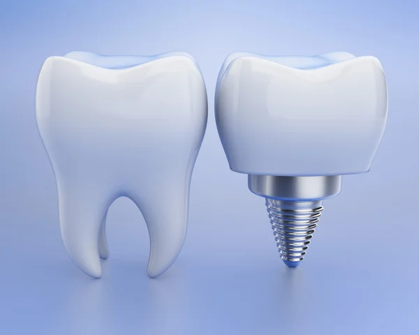 Tand en dental implant — Stockfoto