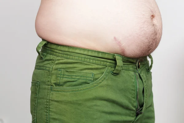 A súlygyarapodás miatt helytelen táplálkozás. Zsíros oldalán és kis nadrág — Stock Fotó