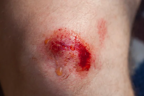 Broken bleeding knee — Stock Photo, Image