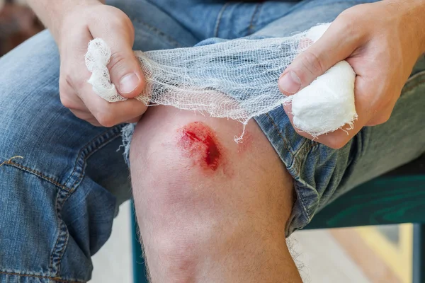 The result of the fall - the damaged knee — Stock Photo, Image
