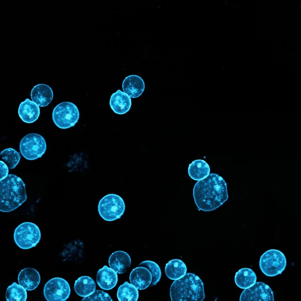 Human leukemic cells under the microscope — Stock Photo, Image