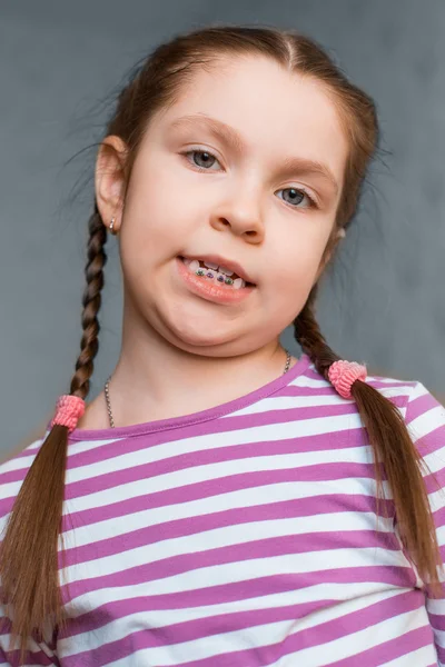 Дівчина з зубними брекетами — стокове фото
