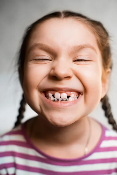 Chica con aparatos dentales — Foto de Stock