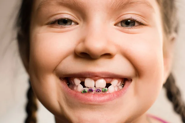 Chica con aparatos dentales —  Fotos de Stock