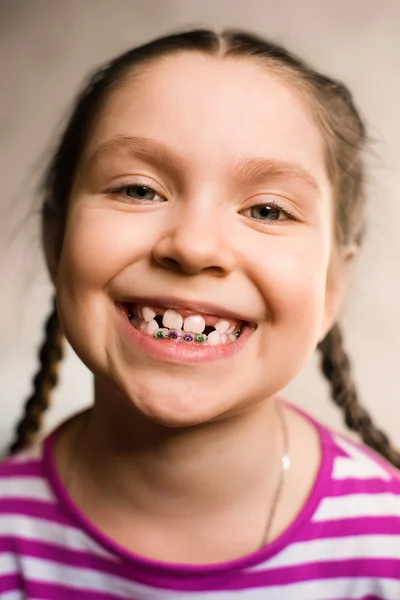 Chica con aparatos dentales — Foto de Stock