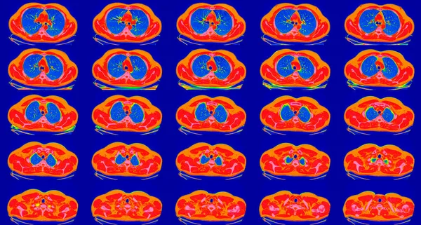 一个健康的成年人肺的电脑断层扫描。正常肺扫描，光谱增强。可能是COVID-19诊断的一部分. — 图库照片