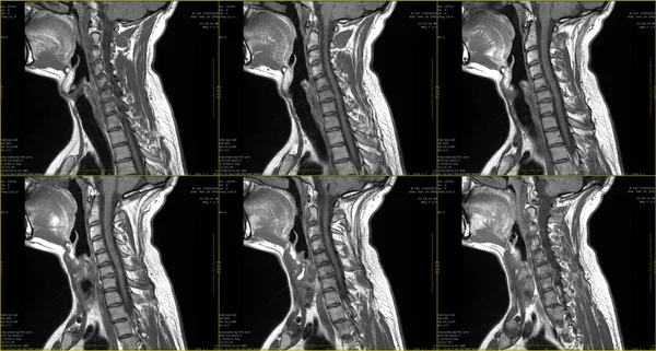 Conjunto de 6 exames de RM sagital de região cervical de homem caucasiano de 34 anos com extrusão paramediana bilateral do segmento C6-C7 com radiculopatia — Fotografia de Stock